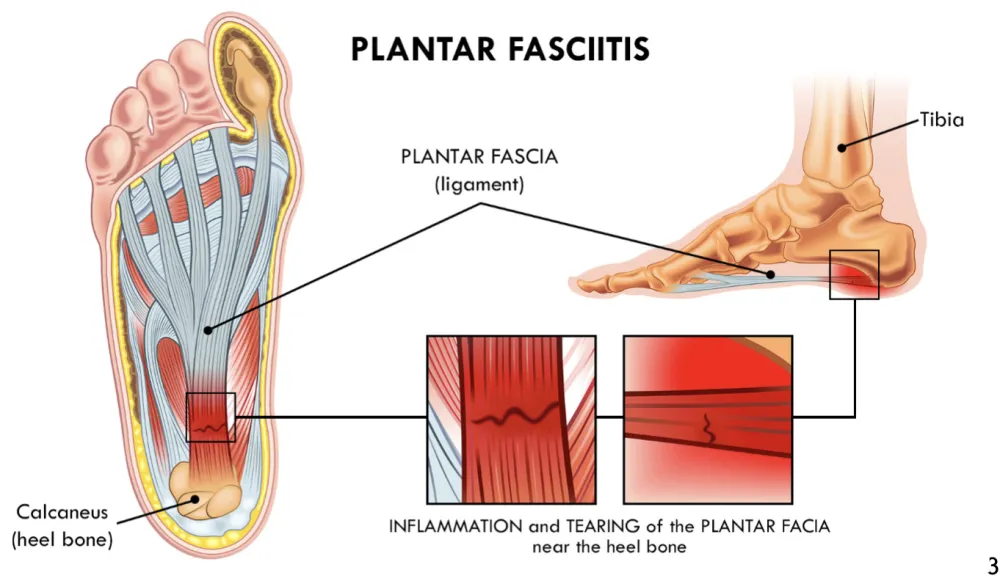plantar fasciitis